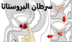 ما أعراض سرطان البروستاتا والأطعمة المحاربة له