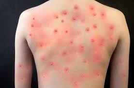 Image result for Monkeypox