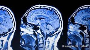 Erbkrankheiten Definition Therapien Netdoktor At