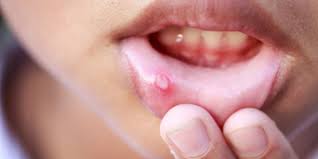 Home Remedies For A Mucocele Mucous Cyst Healthy Food Comunity Mouth Ulcer Home Remedy Canker Sore Mouth Ulcers