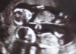 Entwicklung Zwillinge Im 4 Monat Ssw 13 Ssw 17 Seite 3 Babywelten Ch