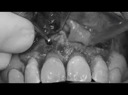 You should return to the dentist that did your root canal to examine your tooth. Root Canal Treatment Munich Harder Mehl