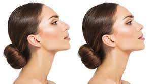 Rhinoplasty Surgery in Detroit