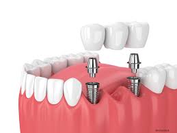 A Dental Bridge Can Replace A Missing Tooth And Provide With Beautiful Results Texas Usa Garland Toothbridge Dental Cirurgia Dentaria Dental Odontologia