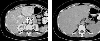 Computed Tomography Of The Abdomen And Pelvis Wikipedia