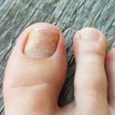 Image result for mykoza nehtů