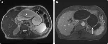 We did not find results for: Retroperitoneal Cystic Masses Magnetic Resonance Imaging Features Springerlink
