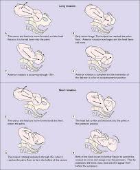 Image result for Manual Rotation in Occipitoposterior Presentation