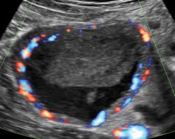 Image result for corpus luteum sonography)