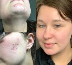 Check spelling or type a new query. 20 Most Incredible Before And After Photos Of Redditors And The Routines That Transformed Their Skin Daily Vanity