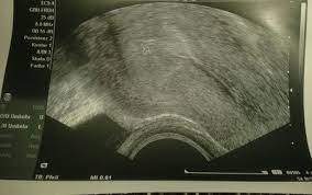 Ultraschall Schwangerschaftsgruppe Babycenter