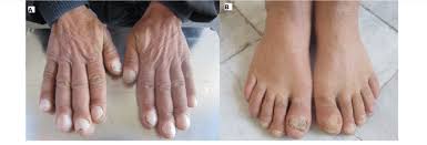 Image result for Clubbing nails feet