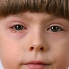 This condition causes forceful, projectile vomiting in infants and must be corrected surgically. Eye Infections In Infants Children Healthychildren Org
