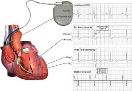 3 letter code (e.g vvi) 1st = chamber paced a (atrial) v (ventricle). Troubleshooting Implanted Cardioverter Defibrillator Sensing Problems I Circulation Arrhythmia And Electrophysiology
