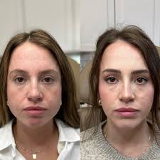 TOP 10 BEST Pdo Thread Lift in Austin, TX