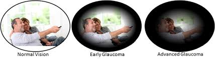 Jul 13, 2021 · the vision loss from glaucoma happens because the optic nerve doesn't get enough nutrients. Glaucoma Management Kirby Eye Centerkirby Eye Center
