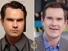 Jimmy Carr Saç Ekimi