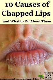 10 Causes Of Chapped Lips, Plus How To Get Rid Of Chapped Lips
