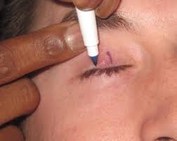 Видео eyelid flip канала oxy zayt. Steps A Denver Eyelid Surgeon Does To Remove A Stye Or Chalazion
