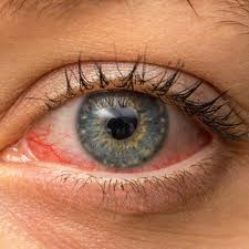 Image result for Dry Eye