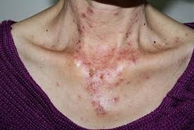 Inflammation caused by lupus can affect many different body systems. Vesiculobullous Diseases In Relation To Lupus Erythematosus Ccid