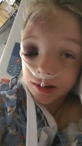 Toddler injured from high chair fall