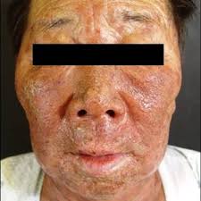 PDF) Stevens-Johnson Syndrome Induced by Vandetanib