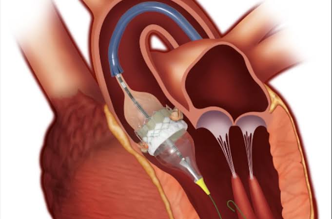 Understanding the TAVR Procedure: A Detailed Guide | Faculty of Medicine