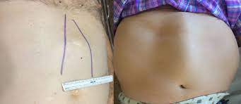 Dudas Sobre La Diastasis De Rectos Clinica Hernia