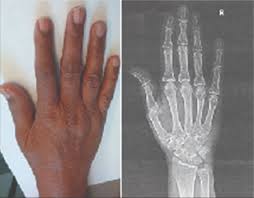 Complex Regional Pain Syndrome Following An Episode Of Herpes Zoster A Case Report Journal Of Orthopaedic Case Reports