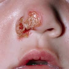 Image result for impetigo baby