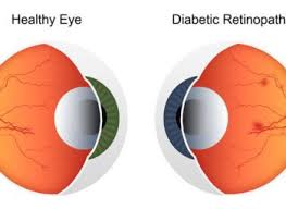 Each of our doctors have worked extensively with patients of all ages and provide the most excellent eye care possible. Blog Ophthalmologist Union City Neovision Eye Center