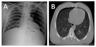 Search only for pneumothorax x ray Ap Chest X Ray Revealing No Evidence Of Pneumothorax Panel A Ct Download Scientific Diagram