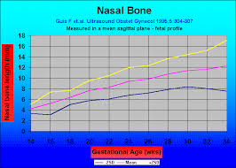 Nasal Bone Guis F Et Al Ultrasound Obstet Gynecol 1995 5 304
