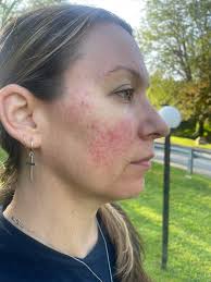 Dermatologists treating hidradenitis suppurativa in Los Angeles