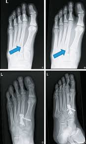 Lisfranc injury or midfoot injury that result if bones in the midfoot are broken or ligaments that support the midfoot are torn. Undisplaced Subtle Ligamentous Lisfranc Injuries Conservative Or Surgical Treatment With Percutaneous Position Screws Sciencedirect
