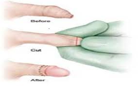 Image result for paraphimosis