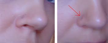 Acv can also kill bacterial growth and clear your skin from inside. What To Do If The Skin Around Your Piercing Turns Gray Or Black Tatring