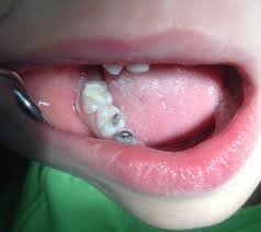 Clinical view of application of 2 mm of white MTA mark Angelus®