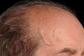 Image result for Jaw Claudication