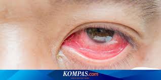 Bulu mata rontok dan bulu mata jatuh mungkin sering kali dipercaya oleh sebagian besar orang indonesia sebagai pertanda sedang ada yang rindu kepada anda. Viral Foto Mata Merah Karena Pembuluh Pecah Akibat Main Ponsel Ini Penjelasan Dokter Halaman All Kompas Com