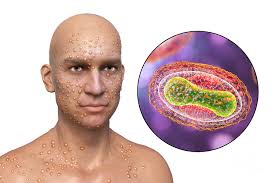Image result for Smallpox