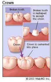 Did You Know That When You Have A Tooth That Is Damaged Or Decay And Can Not Be Repaired With A Filling Crowns Are You Dental Crowns Dental Cosmetic Dentistry