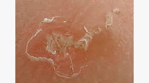 Image result for scabies in the groin area