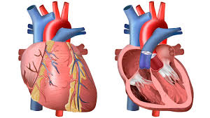 Bleeding, also known as a hemorrhage, haemorrhage, or simply blood loss, is blood escaping from the circulatory system from damaged blood vessels. Heart And Circulation Outside And Inside Bioed Online