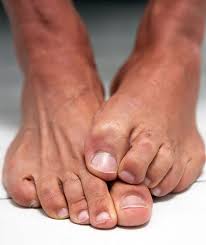 You can also use epsom salts; Smelly Feet Remedy Get Rid Of Bad Foot Odour Within A Week With Hibiscrub Express Co Uk