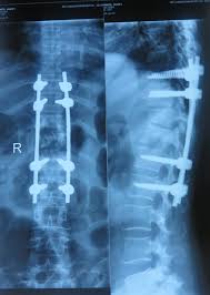 Image result for Spinal Infection