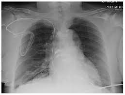 Can you have an mri with a pacemaker. Mri Is Safe For Pacemaker Patients Opening The Door For Needed Exams
