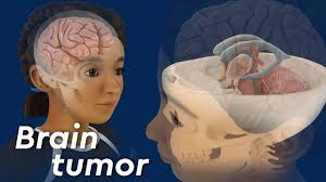 A brain tumor is a mass of abnormal cells in the brain. Craniopharyngioma Children S Hospital Colorado