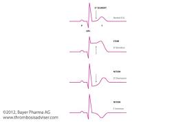 Pain compatible with angina pectoris and. Understanding Differences Between Stemi And Nstemi Nurse Nursing Mnemonics Nursing Tips